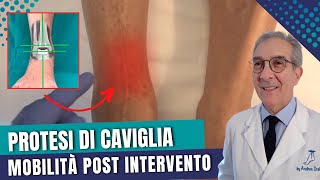 PROTESI DI CAVIGLIA post intervento e mobilità  Dott Andrea Scala [upl. by Neelasor60]