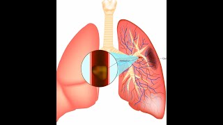 Pulmonary Embolism [upl. by Iliak]