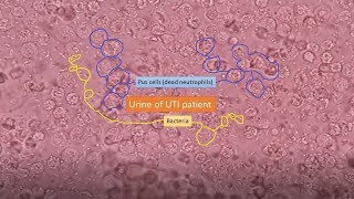 Urine of UTI patient under the Microscope [upl. by Teerprug107]