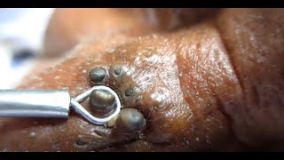 Big Big Comedones blackhead popping ever blackhead removal most satisfying blackheads extraction [upl. by Gaye888]