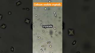 Calcium oxalate crystals in urine [upl. by Pappano]