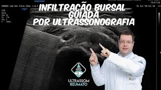 Infiltração bursal guiada por Ultrassonografia [upl. by Itirp]