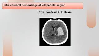 Intracranial Hemorrhage  Radiology [upl. by Anem980]