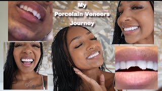 I Got Veneers in Beverly Hills by Dr Joshua Ghiam [upl. by Ecirbaf824]