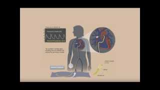 Right Heart Catheterization [upl. by Philomena]