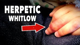 HERPES ON HER FINGER Herpetic Whitlow  Dr Paul [upl. by Akcirehs]