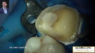 Expert Crown Cementation with Rubber Dam Precision and Efficiency by Dr Ariel Savion [upl. by Huntley]