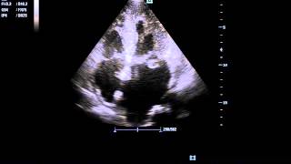 Mitral Valve Vegetation [upl. by Yelich]