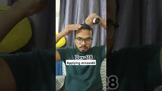 Day 28 Hair Regrowth journey Applying minoxidil bald minoxidil minoxidilresult hairloss [upl. by Weikert]