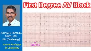 First Degree AV Block [upl. by Atinuahs]