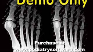 Foot Surgical Animations Part 1 [upl. by Attlee703]