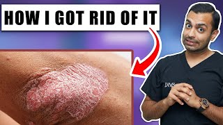 What is Psoriasis  How to get rid of Psoriasis  Dr Somji amp Dr Solomon [upl. by Ecirtal933]