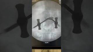 How is Spine vertebroplasty kyphoplasty done  Dr Ajay Kothari  Sancheti Hospital [upl. by Farmelo481]