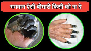 एक एसी खतरनाक बीमारी  Gangrene Symptoms and causes  gangrene kyu hota hai  Dr tarun [upl. by Naot]