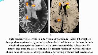 white matter disease with radiologic pathologic correlation [upl. by Eillac]