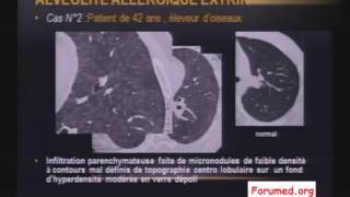 Imagerie des pneumopathies et Fibrose Pulmonaire [upl. by Yeaton965]