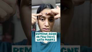 Pimples removal on face at home no side effects acne short shortsfeed shortvideoviral [upl. by Ahsial]