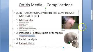 ENT Complications of Otitis Media Acute Chronic AtticoAntral CSOM middle ear infection result [upl. by Dita624]