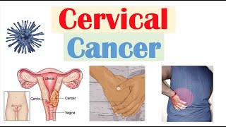 Cervical Cancer Risk Factors Pathophysiology Symptoms Staging Diagnosis Treatment amp Prevention [upl. by Kroo]