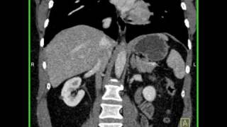 Abdomen Liver Hemangioma of the Liver6 of 8 [upl. by Aicileb]