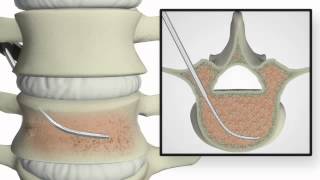 Confidence vertebroplasty [upl. by Yelraf]