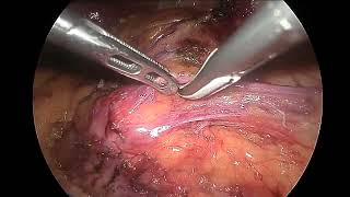 Lap Retroperitoneal Tumour resection [upl. by Talbert867]