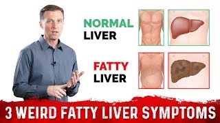 3 Weird Signs amp Symptoms Of Fatty Liver – DrBerg [upl. by Velleman]