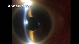 Aphakic eye [upl. by Neelrihs]