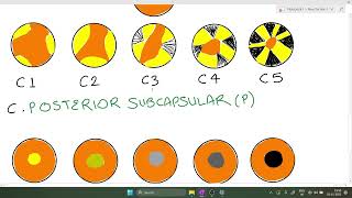 Classification of CataractLOCS III System [upl. by Akitan873]