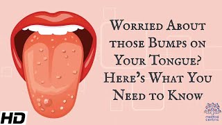 Worried About Those Bumps on Your Tongue Heres What You Need To Know [upl. by Aidne]