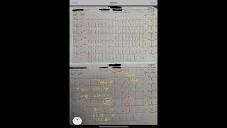 ECG 13 TREADMILL TEST TMT POSITIVE  HOW TO COME TO KNOW [upl. by Barkley]