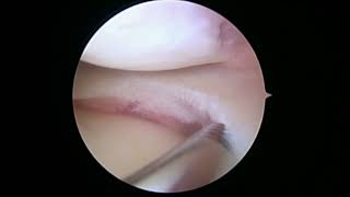 L knee partial lateral menisectomy and OATS 9 19 24 ED [upl. by Peugia]