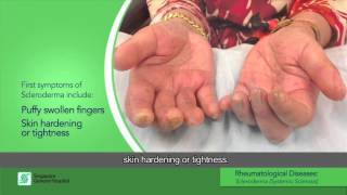 What is Scleroderma also known as Systemic Sclerosis [upl. by Norah]