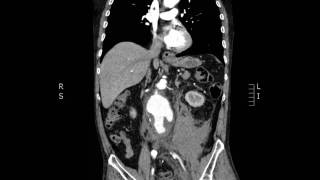 Ruptured AAA Coronal CT JETem 2017 [upl. by Yeldua]