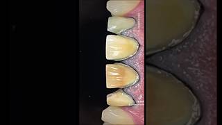 Veneer Preparation Under 60 Seconds veneers [upl. by Alister]