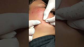 Best Pimple Popping 20 cute reels facts fashion beautiful blackheads sacdepspa hindi [upl. by Eilrahs]