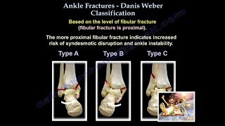 Ankle Fractures Danis Weber Classification  Everything You Need To Know  Dr Nabil Ebraheim [upl. by Jen801]