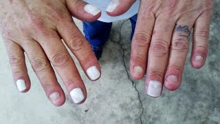 Womans 50Year Nail Biting Habit Is Ruining Her Life [upl. by Link]