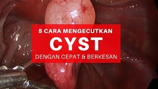 5 Cara Hilangkan Cyst Dengan Cepat Dan Paling Selamat Kecut Hanya 2 Minggu [upl. by Anitel753]