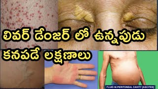 Liver Disease and Symptoms Detailed Video in Telugu [upl. by Haveman]