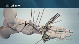 DynaBunion™ 4D MinimalIncision Lapidus System  Narrated Animation [upl. by Nylknarf692]