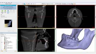 Orthognathics Part I PrePlanning  PROPLAN CMF™ [upl. by Clapp534]