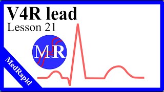 V4R in EKG [upl. by Alletniuq]