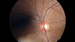 Optic Disc  Spontaneous Venous Pulsations [upl. by Yrod403]