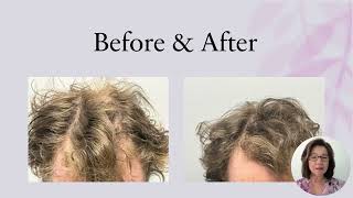 Natural Hair Loss Treatment for Men [upl. by Acirdna]