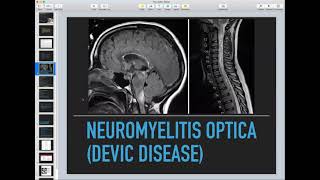 Transverse Myelitis Neuromyelitis Optica Acute Disseminated Encephalomyelitis  Neurology Course [upl. by Azalea]