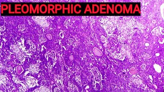 Benign Mixed Tumour of Salivary Gland  Pleomorphic Adenoma Histopathology [upl. by Annelg]