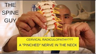 CERVICAL STENOSIS RADICULOPATHY PART 1  SYMPTOMS IMAGING AND PATIENT EXAM [upl. by Ruthe]