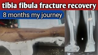 tibia fibula fracture recovery 8 months my journey mujhy aaj 8 mahene hugye [upl. by Chenee]