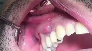 Popping a Tooth Abscess [upl. by Enelyaj]